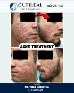 Acne Treatment in Udhampur