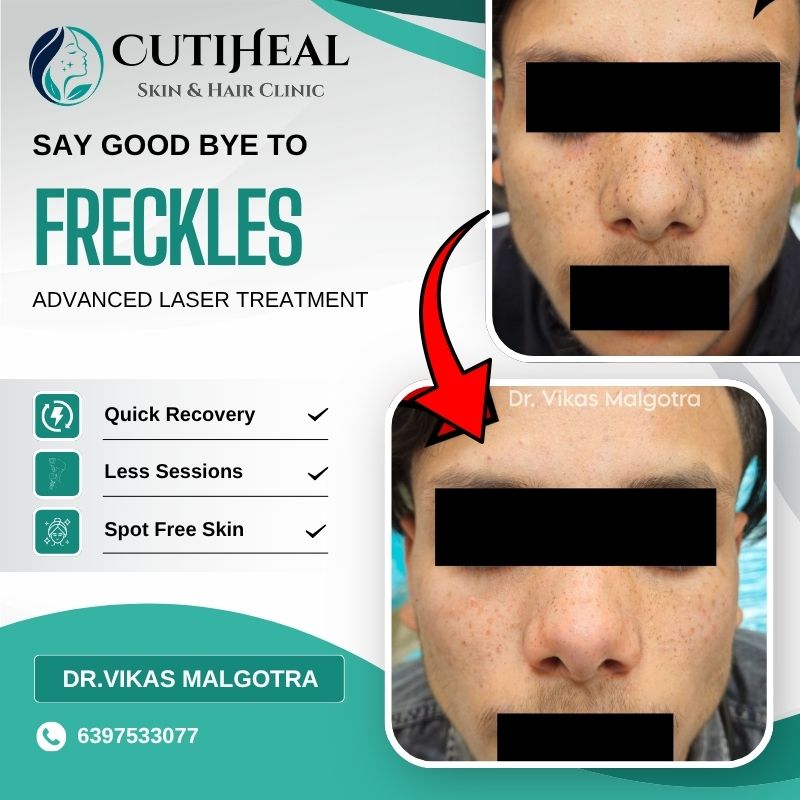 Freckles Treatment in Udhampur