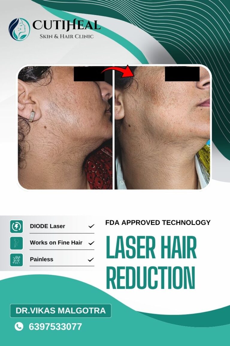 Laser hair removal in Udhampur