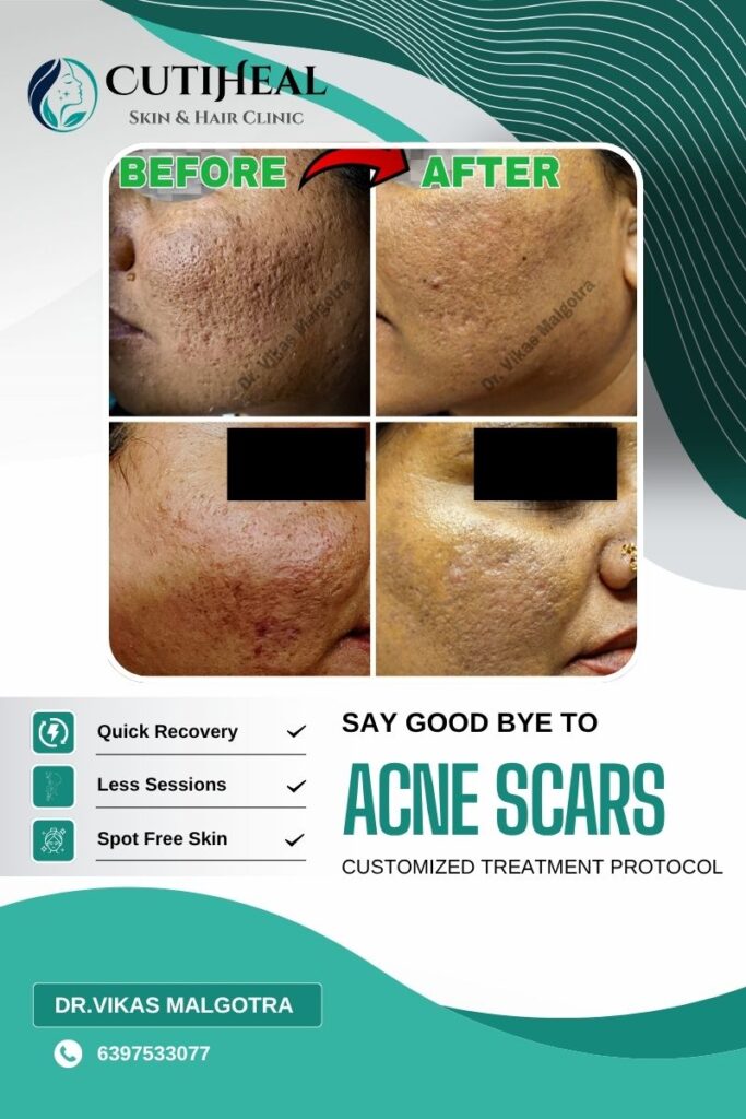 Scar Treatment in Udhampur